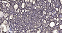 Immunohistochemical analysis of paraffin-embedded human liver cancer. 1, Antibody was diluted at 1:200 (4° overnight). STJ92014