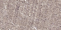 Immunohistochemical analysis of paraffin-embedded human small intestinal carcinoma tissue. 1, Primary antibody was STJ92062