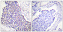 Immunohistochemistry analysis of paraffin-embedded human breast carcinoma tissue, using CD40 Antibody. The picture on the right is blocked with the synthesized peptide. Immunohistochemistry analysis of paraffin-embedded human breast carcinoma tissue, using CD40 Antibody. The picture on the right is blocked with the synthesized peptide.