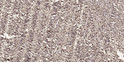 Immunohistochemical analysis of paraffin-embedded human small intestinal carcinoma tissue. 1, Primary antibody was STJ92167