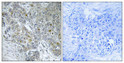 Immunohistochemical analysis of paraffin-embedded Human breast cancer. Antibody was diluted at 1:100 (4°C overnight). High-pressure and temperature Tris-EDTA, pH8.0 was used for antigen retrieval. Negetive contrl (right) obtaned from antibody was pre-absorbed by immunogen peptide.