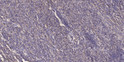 Immunohistochemical analysis of paraffin-embedded human colon cancer. 1, Antibody was diluted at 1:200 (4° overnight). STJ92232