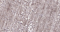 Immunohistochemical analysis of paraffin-embedded human colon cancer. 1, Antibody was diluted at 1:200 (4° overnight). STJ92365
