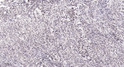 Immunohistochemical analysis of paraffin-embedded human small intestinal stromal tumor. 1, Tris-EDTA, pH 9.0 was used STJ92510