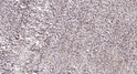 Immunohistochemical analysis of paraffin-embedded human colon cancer. 1, Antibody was diluted at 1:200 (4° overnight). STJ92511