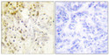 Immunohistochemistry analysis of paraffin-embedded human breast carcinoma tissue, using Cyclin L1 Antibody. The picture on the right is blocked with the synthesized peptide.