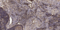 Immunohistochemical analysis of paraffin-embedded human squamous cell carcinoma of lung. 1, Antibody was diluted at STJ92560