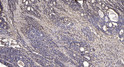 Immunohistochemical analysis of paraffin-embedded human gastric adenocarcinoma. 1, Antibody was diluted at 1:200 (4°C STJ92568