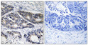 Immunohistochemistry analysis of paraffin-embedded human colon carcinoma, using Cytochrome P450 2R1 Antibody. The picture on the right is blocked with the synthesized peptide. Immunohistochemistry analysis of paraffin-embedded human colon carcinoma, using Cytochrome P450 2R1 Antibody. The picture on the right is blocked with the synthesized peptide.