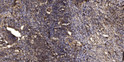 Immunohistochemical analysis of paraffin-embedded human squamous cell carcinoma of lung. 1, Antibody was diluted at STJ92595