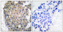 Immunohistochemistry analysis of paraffin-embedded human breast carcinoma tissue, using Keratin 17 Antibody. The picture on the right is blocked with the synthesized peptide.