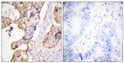 Immunohistochemistry analysis of paraffin-embedded human colon carcinoma tissue, using Keratin 8 Antibody. The picture on the right is blocked with the synthesized peptide.