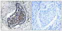 Immunohistochemical analysis of paraffin-embedded Human lung cancer. Antibody was diluted at 1:100 (4°C overnight). High-pressure and temperature Tris-EDTA, pH8.0 was used for antigen retrieval. Negetive contrl (right) obtaned from antibody was pre-absorbed by immunogen peptide.