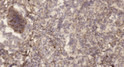 Immunohistochemical analysis of paraffin-embedded human lung cancer. 1, Antibody was diluted at 1:200 (4° overnight). STJ92670