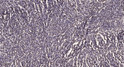 Immunohistochemical analysis of paraffin-embedded human brain tumor. 1, Antibody was diluted at 1:200 (4° overnight). STJ92674
