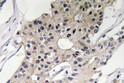 Immunohistochemistry analysis of Defensin α1 antibody in paraffin-embedded human breast carcinoma tissue. STJ92687