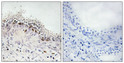 Immunohistochemical analysis of paraffin-embedded Human prostate cancer. Antibody was diluted at 1:100 (4°C overnight). High-pressure and temperature Tris-EDTA, pH8.0 was used for antigen retrieval. Negetive contrl (right) obtaned from antibody was pre-absorbed by immunogen peptide.