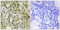 Immunohistochemistry analysis of paraffin-embedded human breast carcinoma tissue, using DTYMK Antibody. The picture on the right is blocked with the synthesized peptide.