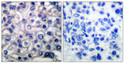 Immunohistochemistry analysis of paraffin-embedded human breast carcinoma tissue, using EGFR Antibody. The picture on the right is blocked with the synthesized peptide.