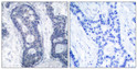 Immunohistochemistry analysis of paraffin-embedded human breast carcinoma tissue, using eIF4E Antibody. The picture on the right is blocked with the synthesized peptide.