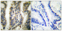 Immunohistochemical analysis of paraffin-embedded Human lung cancer. Antibody was diluted at 1:100 (4°C overnight). High-pressure and temperature Tris-EDTA, pH8.0 was used for antigen retrieval. Negetive contrl (right) obtaned from antibody was pre-absorbed by immunogen peptide.