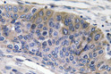 Immunohistochemistry analysis of IgG1 antibody in paraffin-embedded human lung carcinoma tissue.