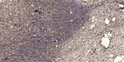 Immunohistochemical analysis of paraffin-embedded human oophoroma. 1, Antibody was diluted at 1:200 (4° overnight). 2, STJ93734