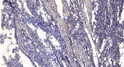 Immunohistochemical analysis of paraffin-embedded human gastric adenocarcinoma. 1, Antibody was diluted at 1:200 (4° STJ93753