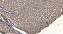 Immunohistochemical analysis of paraffin-embedded human liver cancer. 1, Antibody was diluted at 1:200 (4° overnight). STJ93803