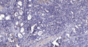 Immunohistochemical analysis of paraffin-embedded human gastric adenocarcinoma. 1, Antibody was diluted at 1:200 (4°C STJ93888