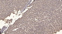 Immunohistochemical analysis of paraffin-embedded human liver cancer. 1, Antibody was diluted at 1:200 (4° overnight). STJ93926