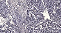Immunohistochemical analysis of paraffin-embedded human gastric adenocarcinoma. 1, Antibody was diluted at 1:200 (4°C STJ93945