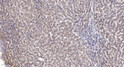 Immunohistochemical analysis of paraffin-embedded human liver cancer. 1, Antibody was diluted at 1:200 (4°C overnight). STJ93948