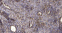 Immunohistochemical analysis of paraffin-embedded human squamous cell carcinoma of lung. 1, Antibody was diluted at STJ93953