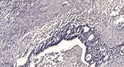 Immunohistochemical analysis of paraffin-embedded human gastric adenocarcinoma. 1, Antibody was diluted at 1:200 (4°C STJ93957