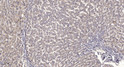 Immunohistochemical analysis of paraffin-embedded human liver cancer. 1, Antibody was diluted at 1:200 (4° overnight). STJ94036