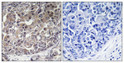 Immunohistochemical analysis of paraffin-embedded Human breast cancer. Antibody was diluted at 1:100 (4°C overnight). High-pressure and temperature Tris-EDTA, pH8.0 was used for antigen retrieval. Negetive contrl (right) obtaned from antibody was pre-absorbed by immunogen peptide.