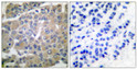 Immunohistochemistry analysis of paraffin-embedded human breast carcinoma tissue, using MMP-8 Antibody. The picture on the right is blocked with the synthesized peptide. Immunohistochemistry analysis of paraffin-embedded human breast carcinoma tissue, using MMP-8 Antibody. The picture on the right is blocked with the synthesized peptide.
