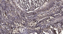 Immunohistochemical analysis of paraffin-embedded human squamous cell carcinoma of the lung. 1, Antibody was diluted at STJ94191