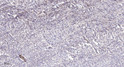 Immunohistochemical analysis of paraffin-embedded human colon cancer. 1, Antibody was diluted at 1:200 (4° overnight). STJ94210