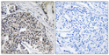 Immunohistochemistry analysis of paraffin-embedded human breast carcinoma tissue, using MRPL24 Antibody. The picture on the right is blocked with the synthesized peptide. Immunohistochemistry analysis of paraffin-embedded human breast carcinoma tissue, using MRPL24 Antibody. The picture on the right is blocked with the synthesized peptide.
