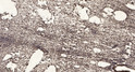 Immunohistochemical analysis of paraffin-embedded human oophoroma. 1, Antibody was diluted at 1:200 (4° overnight). 2, STJ94263