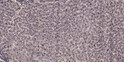 Immunohistochemical analysis of paraffin-embedded human liver cancer. 1, Antibody was diluted at 1:200 (4°C overnight). STJ94291