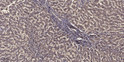 Immunohistochemical analysis of paraffin-embedded human liver cancer. 1, Antibody was diluted at 1:200 (4°C overnight). STJ94307