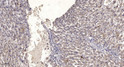 Immunohistochemical analysis of paraffin-embedded human liver cancer. 1, Antibody was diluted at 1:200 (4° overnight). STJ94317