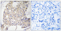 Immunohistochemistry analysis of paraffin-embedded human breast carcinoma tissue, using NDRG3 Antibody. The picture on the right is blocked with the synthesized peptide. Immunohistochemistry analysis of paraffin-embedded human breast carcinoma tissue, using NDRG3 Antibody. The picture on the right is blocked with the synthesized peptide.