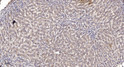 Immunohistochemical analysis of paraffin-embedded human liver cancer. 1, Antibody was diluted at 1:200 (4° overnight). STJ94426