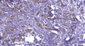 Immunohistochemical analysis of paraffin-embedded human breast cancer. 1, Antibody was diluted at 1:200 (4°C STJ94436