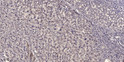 Immunohistochemical analysis of paraffin-embedded human liver cancer. 1, Antibody was diluted at 1:200 (4°C overnight). STJ94453