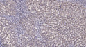Immunohistochemical analysis of paraffin-embedded human liver cancer. 1, Antibody was diluted at 1:200 (4° overnight). STJ94454